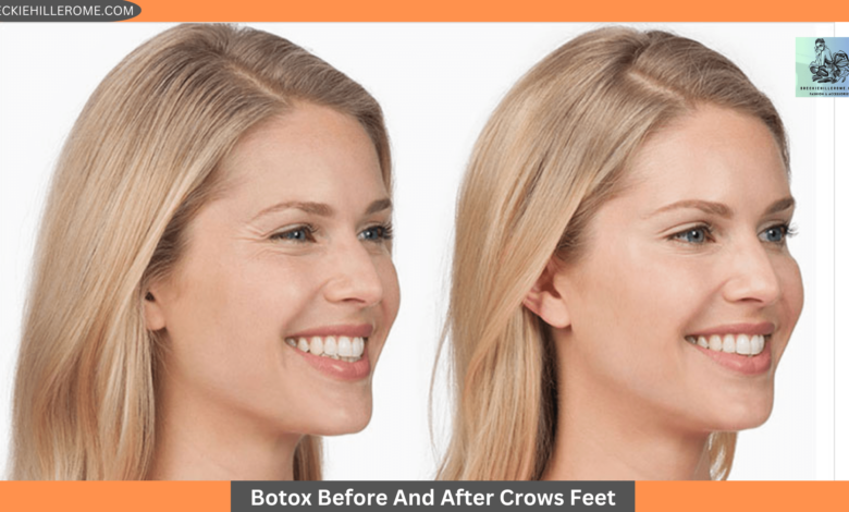 Botox Before And After Crows Feet